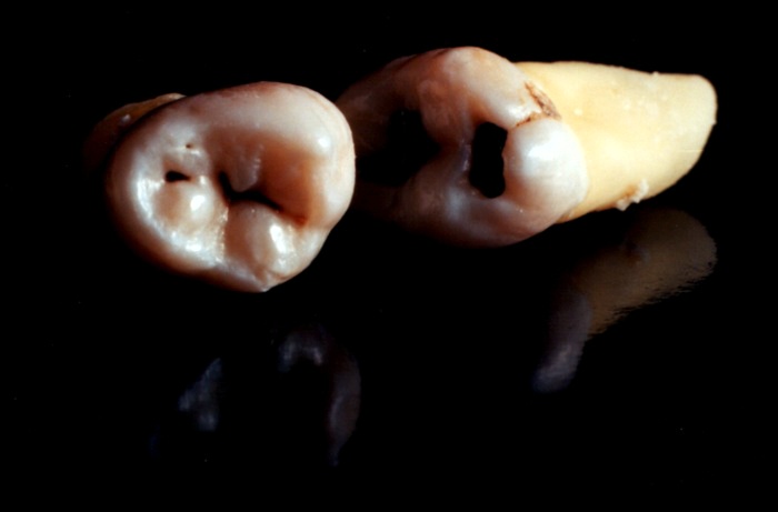 wisdom teeth